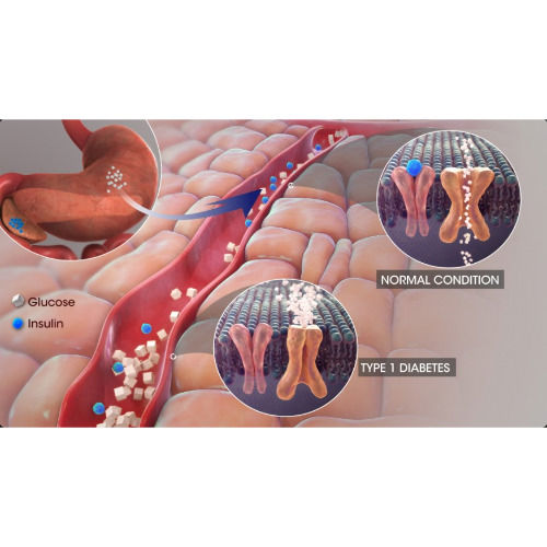 নীরব ঘাতক "ডায়াবেটিস" রোগ: কী, কেন হয়, প্রকারভেদ, ঝুঁকি ও প্রতিকার